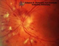Multiple patches of cotton-wool spots and superficial flame-shaped hemorrhages.